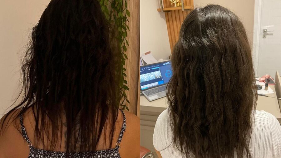 Antes e depois do tratamento capilar, paciente 1