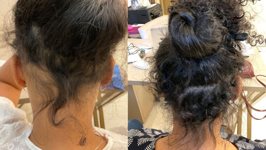 Antes e depois do tratamento capilar, paciente 2