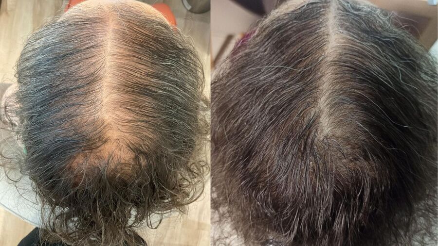 Antes e depois do tratamento capilar, paciente 3