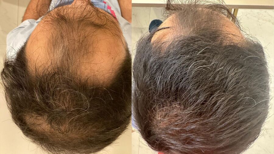 Antes e depois do tratamento capilar, paciente 4